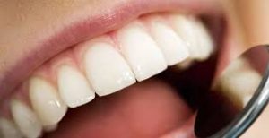 smiling mouth with white teeth dental conservative dentistry fotona red deer