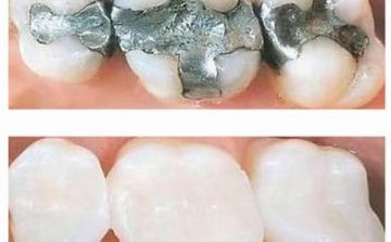 isotope_fillings